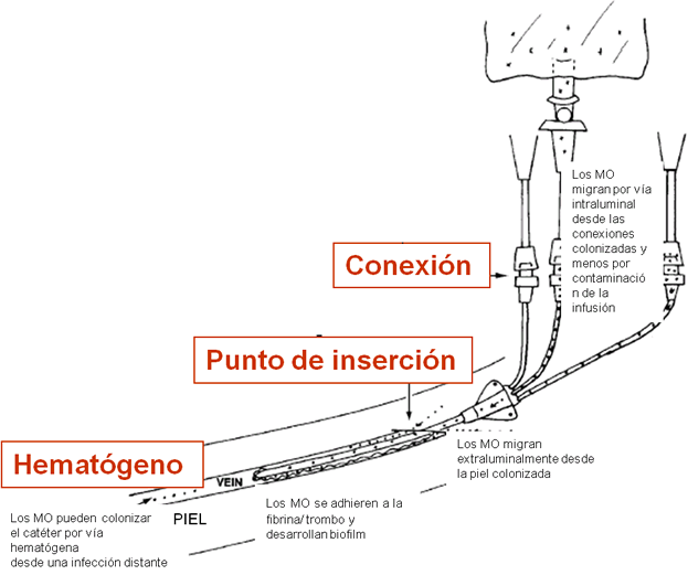 Focos de  infección de CVC